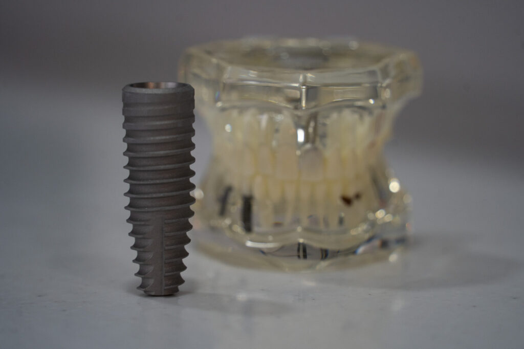  model of teeth with dental implant screw
