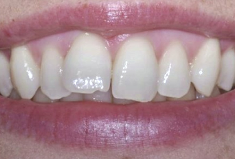 Fix crowded teeth.