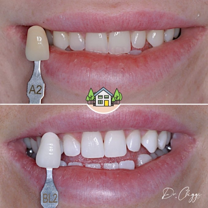 Professional teeth whitening