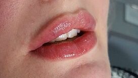 Lip fillers example